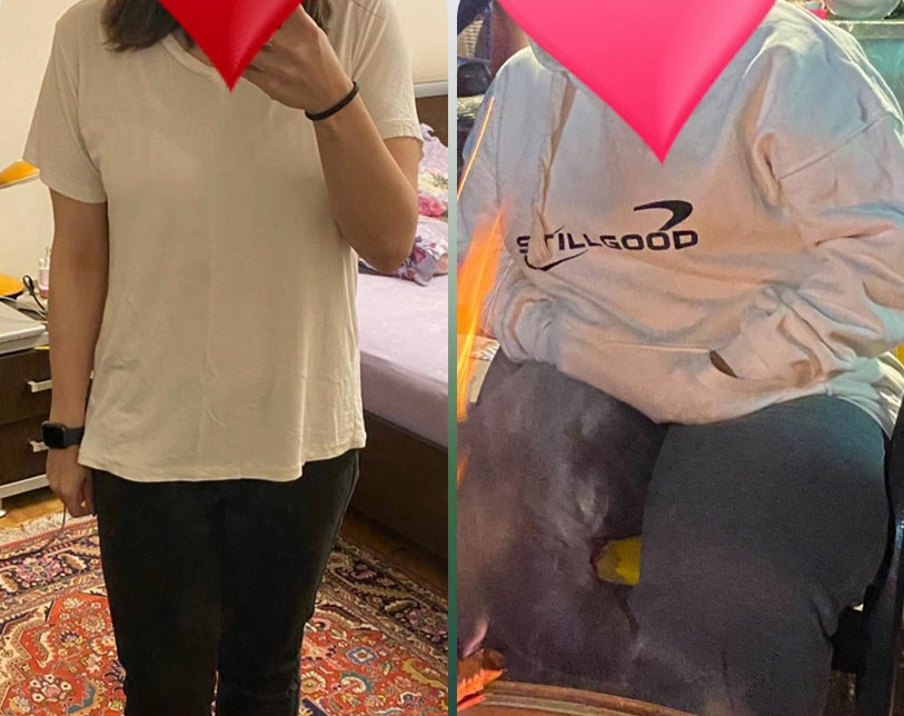 اسلیو و بای پس معده